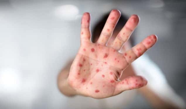 Fruit continues to spread to Kosovo, 242 confirmed cases and 18 just during last week