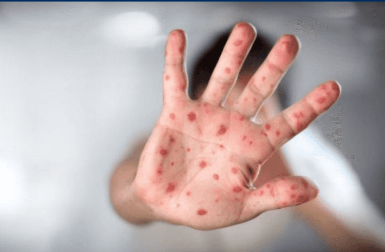 For an 18th week of new measles, 242 cases in April