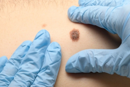 Dermatologët në Maqedoni zbulojnë raste të dyshimta të kancerit të lëkurës gjatë kontrolleve falas